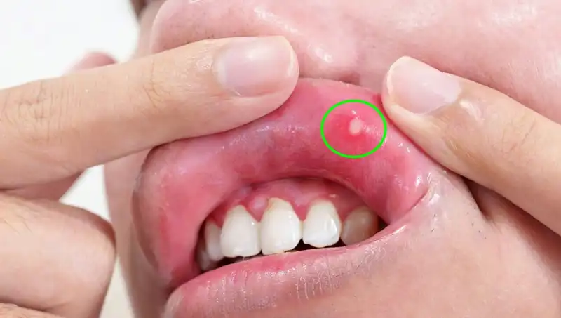 Vücudunuzun Alarmı: B Vitamini Eksikliği Belirtilerini Keşfedin!